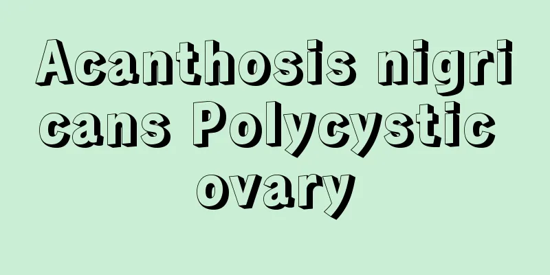 Acanthosis nigricans Polycystic ovary