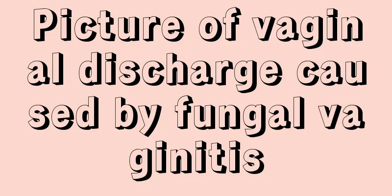 Picture of vaginal discharge caused by fungal vaginitis