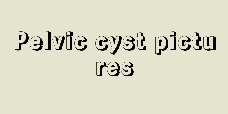 Pelvic cyst pictures