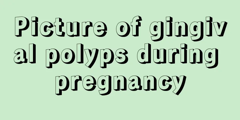 Picture of gingival polyps during pregnancy