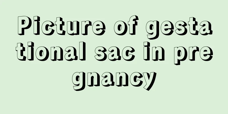 Picture of gestational sac in pregnancy