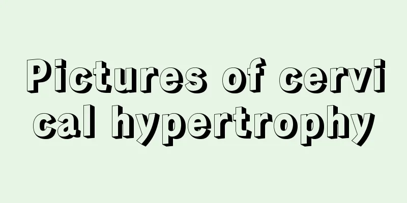 Pictures of cervical hypertrophy