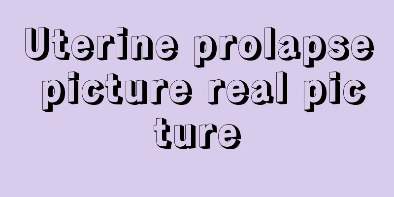 Uterine prolapse picture real picture