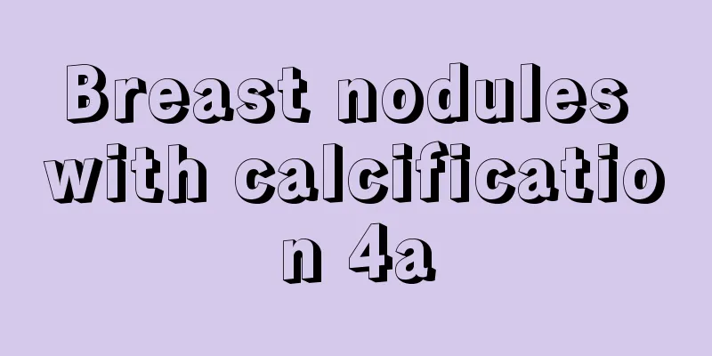 Breast nodules with calcification 4a