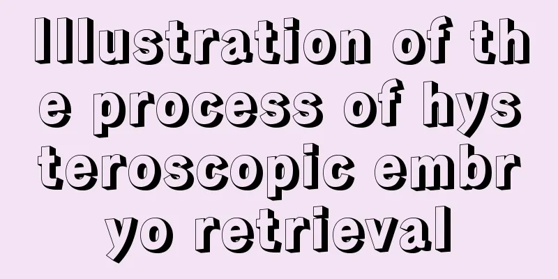 Illustration of the process of hysteroscopic embryo retrieval