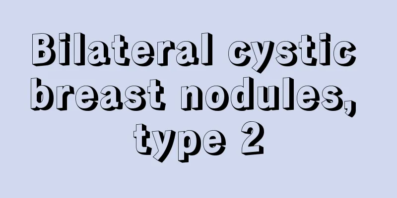 Bilateral cystic breast nodules, type 2