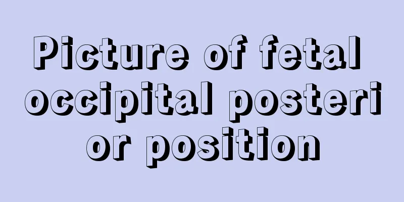 Picture of fetal occipital posterior position