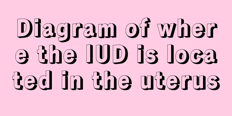 Diagram of where the IUD is located in the uterus