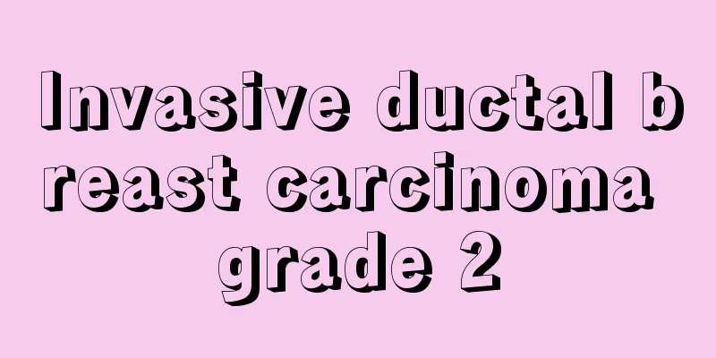 Invasive ductal breast carcinoma grade 2