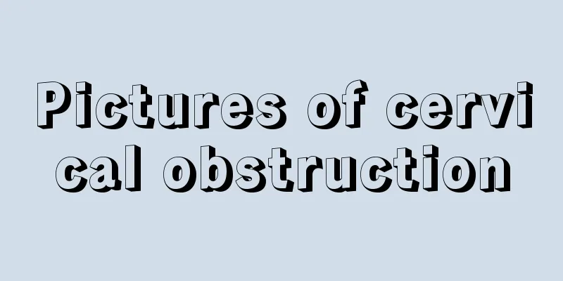 Pictures of cervical obstruction