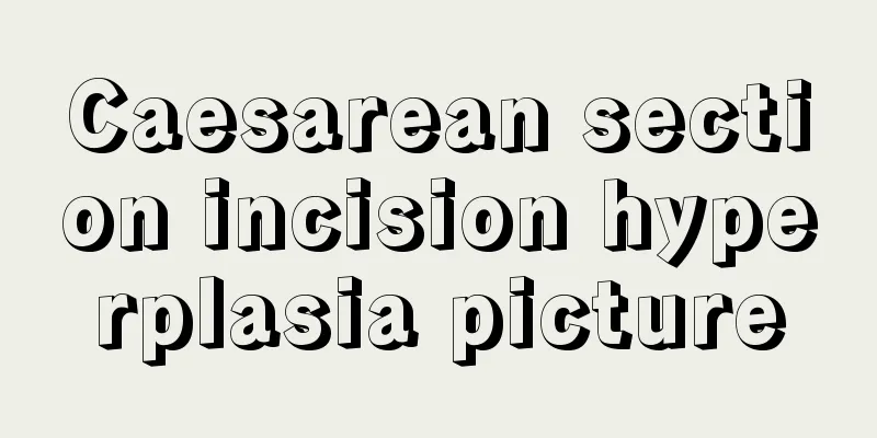 Caesarean section incision hyperplasia picture