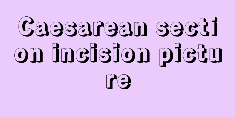 Caesarean section incision picture