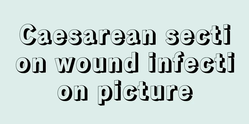 Caesarean section wound infection picture