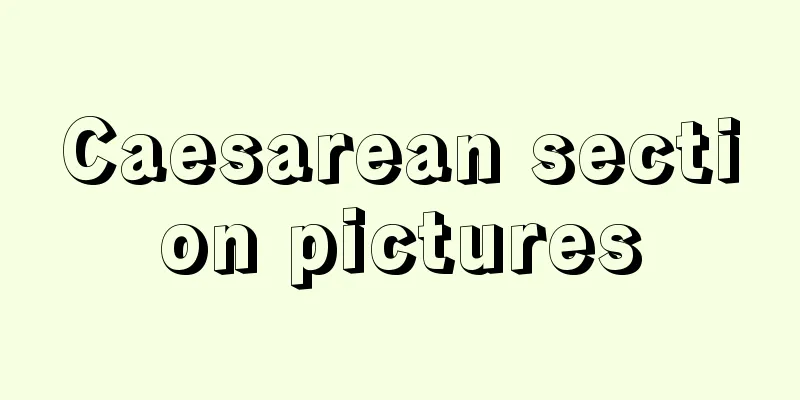 Caesarean section pictures