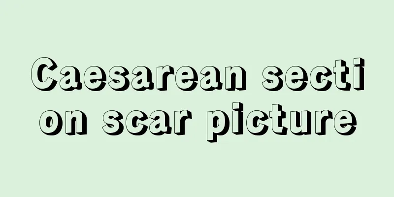 Caesarean section scar picture