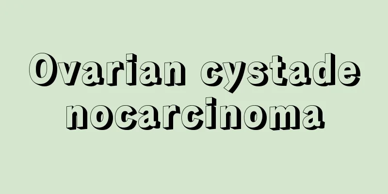 Ovarian cystadenocarcinoma