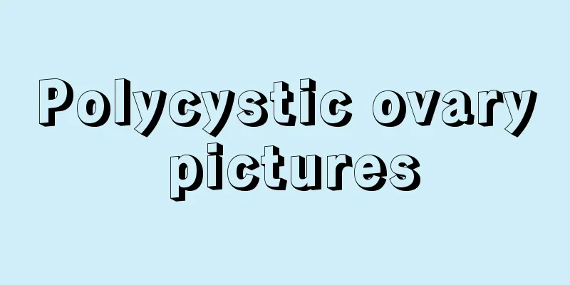 Polycystic ovary pictures