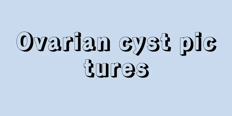 Ovarian cyst pictures