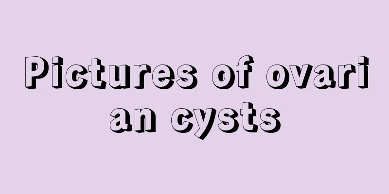 Pictures of ovarian cysts