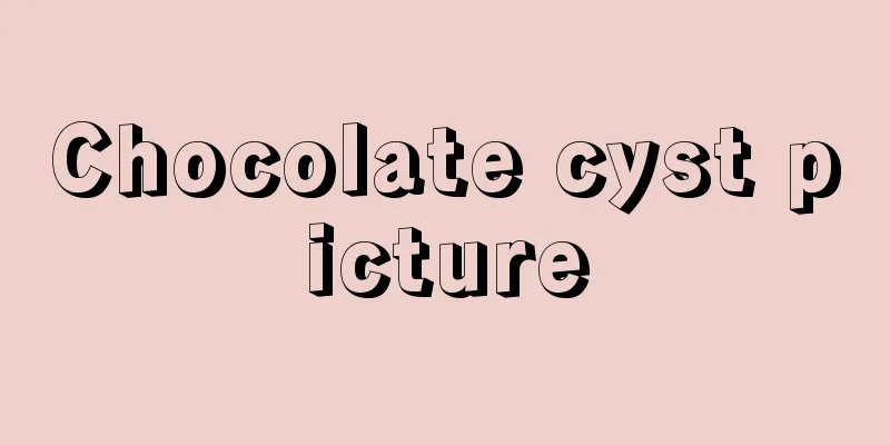 Chocolate cyst picture