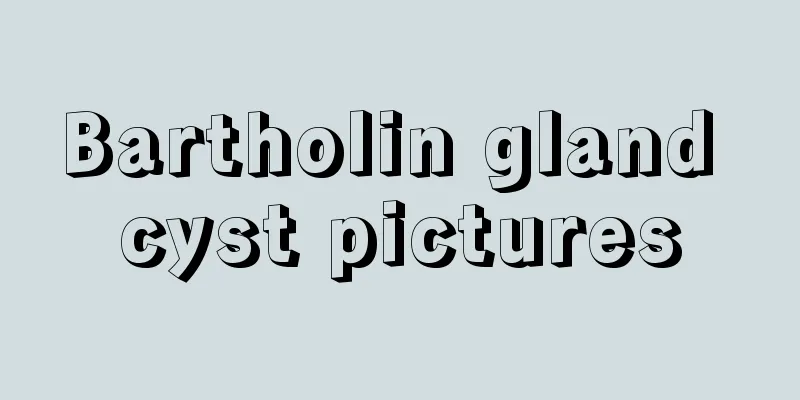 Bartholin gland cyst pictures