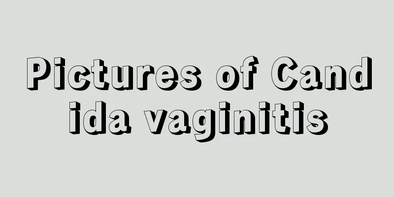 Pictures of Candida vaginitis