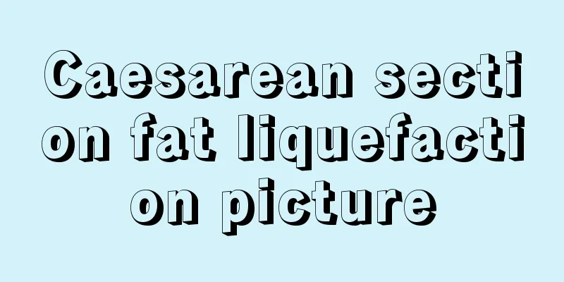 Caesarean section fat liquefaction picture