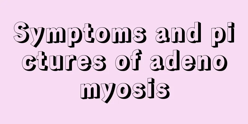 Symptoms and pictures of adenomyosis