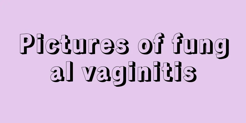 Pictures of fungal vaginitis