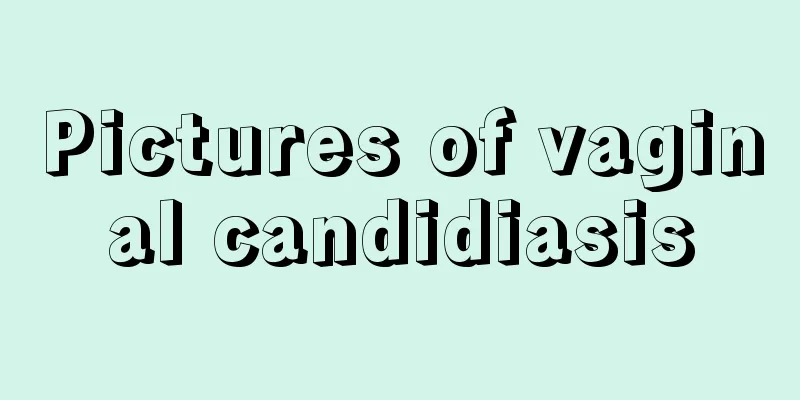 Pictures of vaginal candidiasis