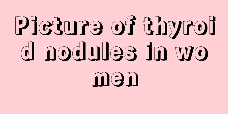 Picture of thyroid nodules in women