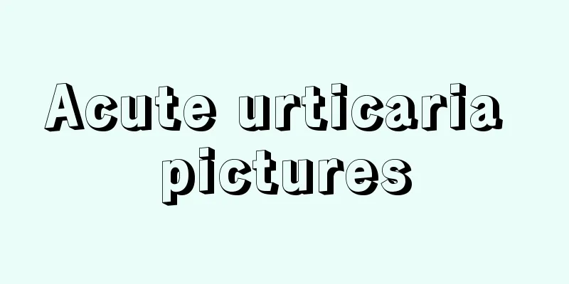 Acute urticaria pictures