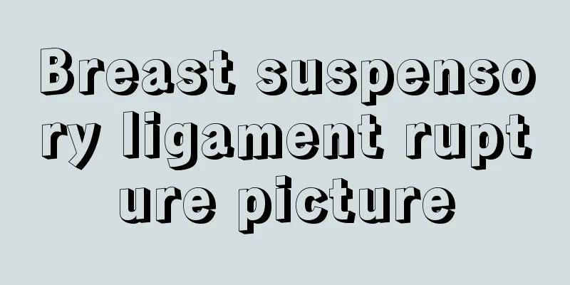 Breast suspensory ligament rupture picture