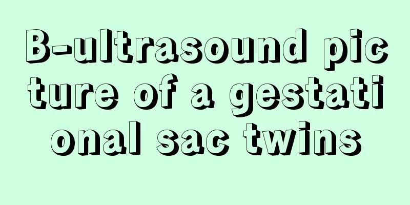 B-ultrasound picture of a gestational sac twins