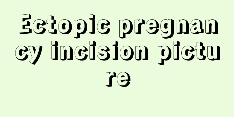 Ectopic pregnancy incision picture