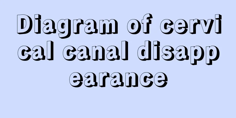 Diagram of cervical canal disappearance