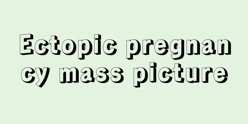 Ectopic pregnancy mass picture