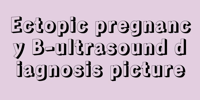 Ectopic pregnancy B-ultrasound diagnosis picture