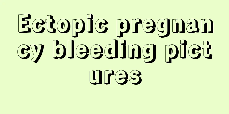 Ectopic pregnancy bleeding pictures