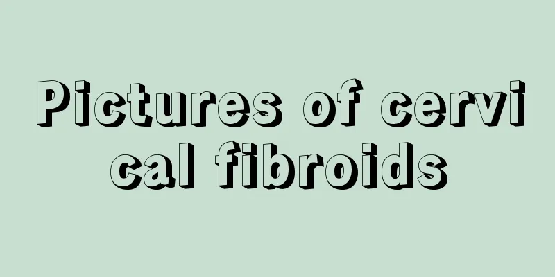 Pictures of cervical fibroids