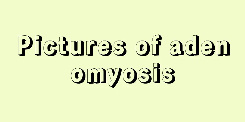 Pictures of adenomyosis