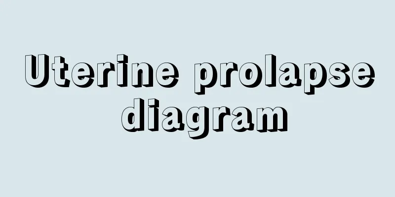 Uterine prolapse diagram