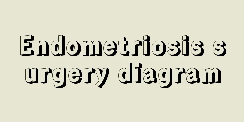 Endometriosis surgery diagram