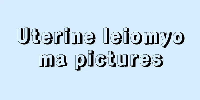 Uterine leiomyoma pictures