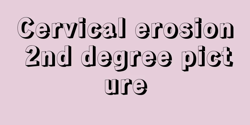 Cervical erosion 2nd degree picture