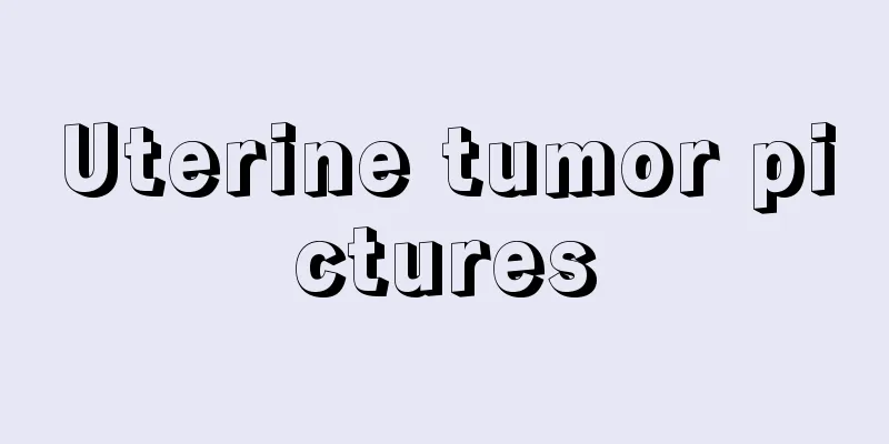 Uterine tumor pictures