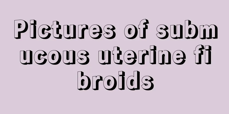 Pictures of submucous uterine fibroids