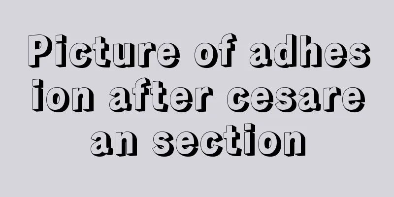 Picture of adhesion after cesarean section