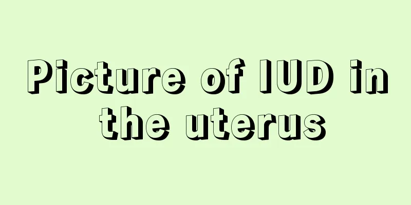 Picture of IUD in the uterus