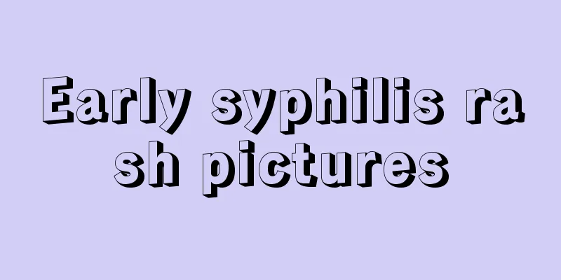 Early syphilis rash pictures